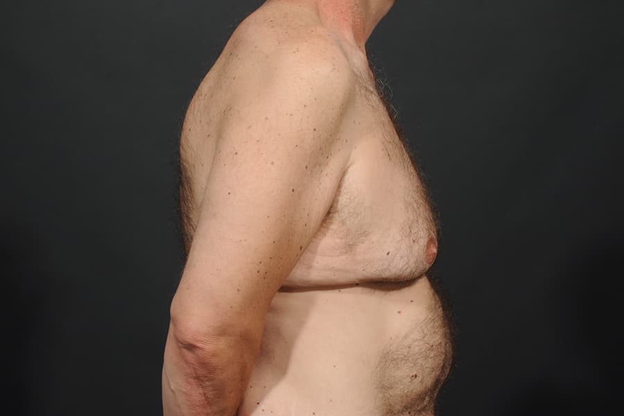 Male Breast Reduction Before & After Image