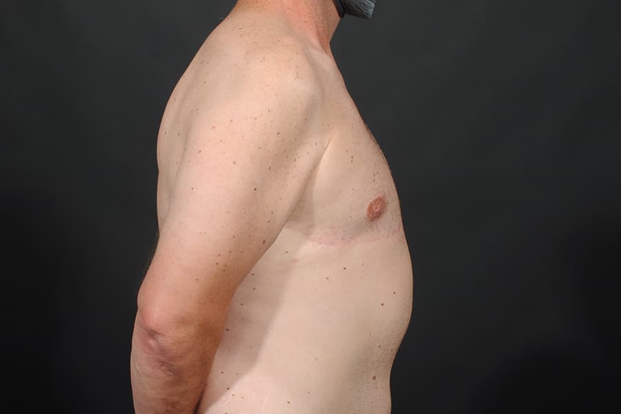 Male Breast Reduction Before & After Image