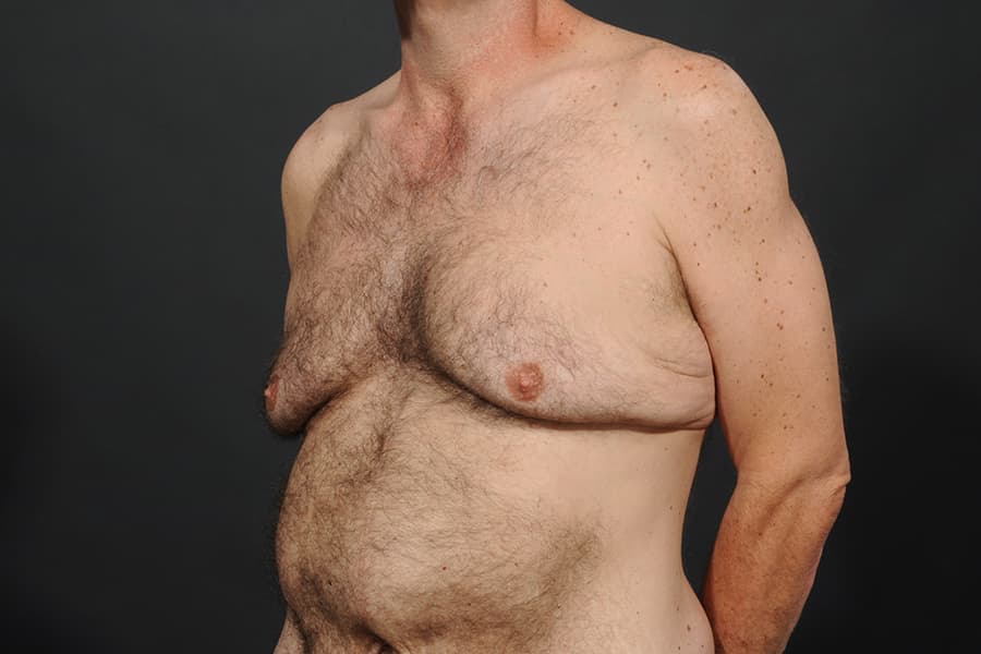 Male Breast Reduction Before & After Image