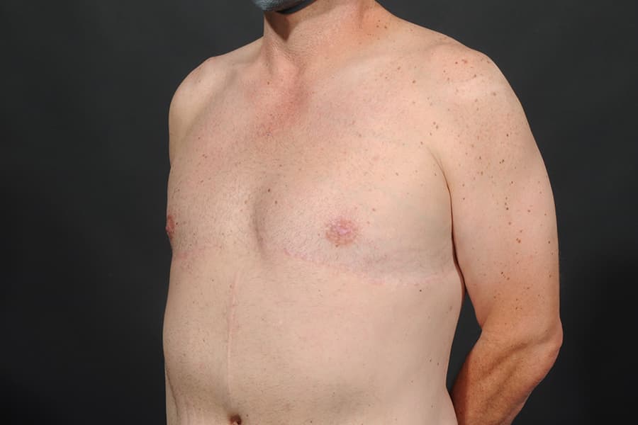 Male Breast Reduction Before & After Image