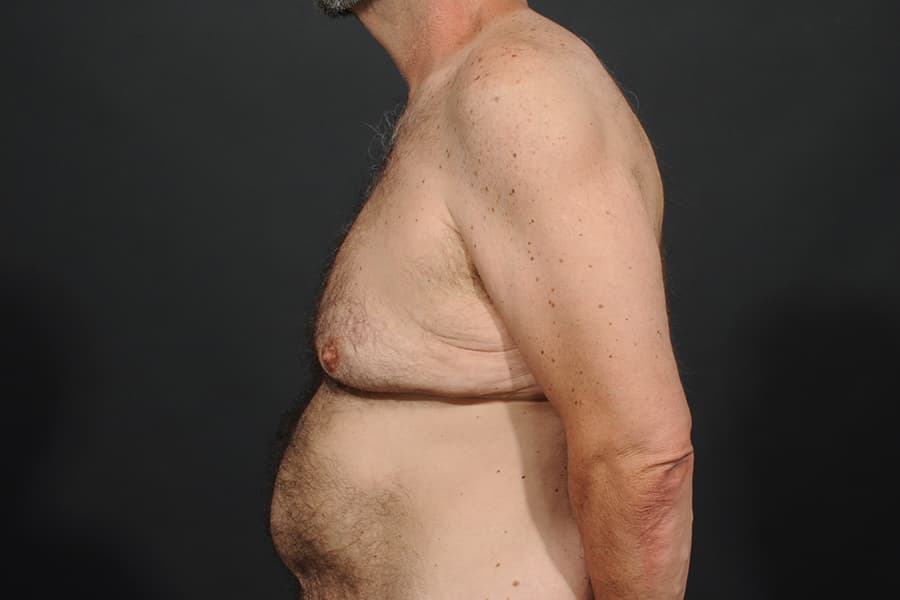 Male Breast Reduction Before & After Image