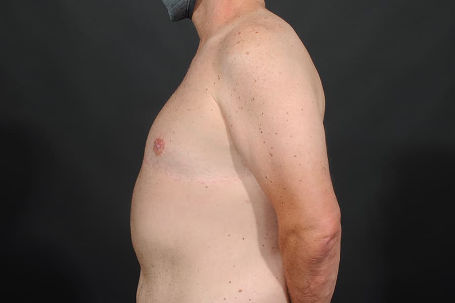 Male Breast Reduction Before & After Image