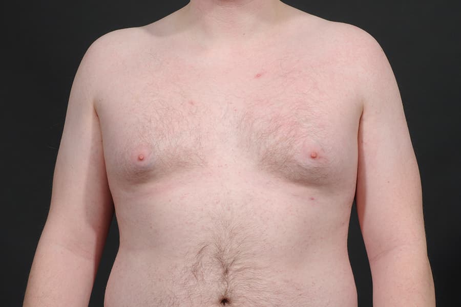 Male Breast Reduction Before & After Image