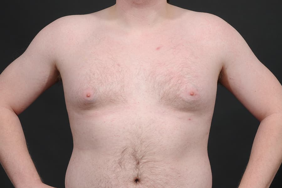 Male Breast Reduction Before & After Image