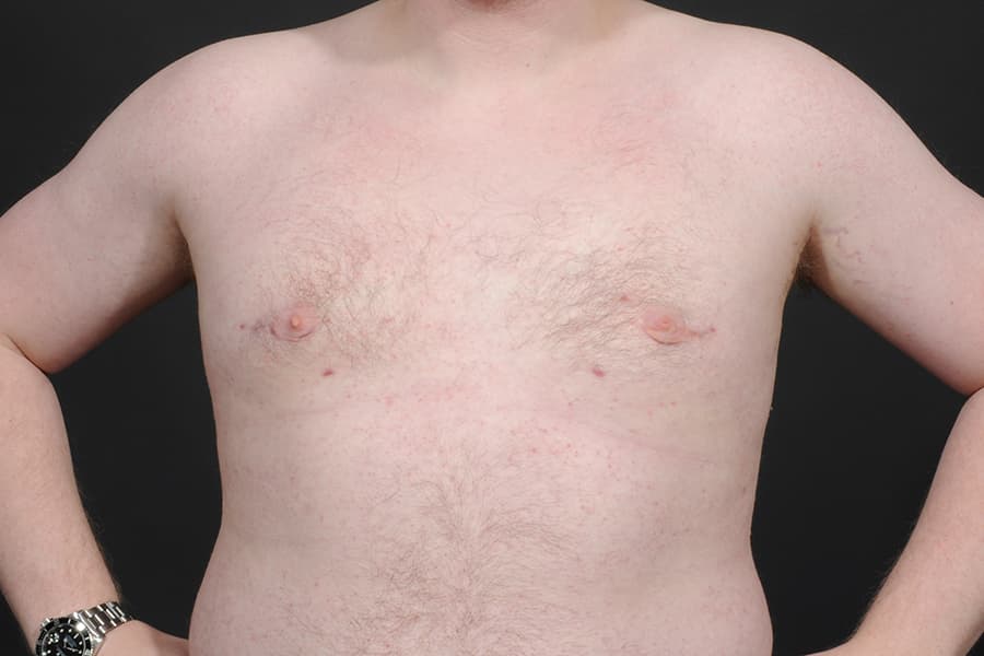 Male Breast Reduction Before & After Image