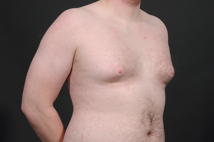 Male Breast Reduction Before & After Image