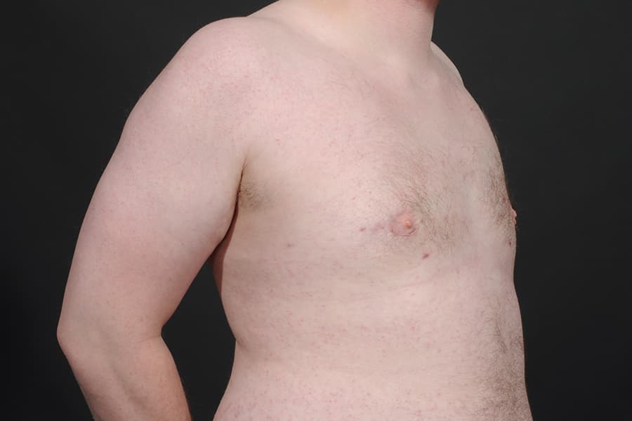 Male Breast Reduction Before & After Image