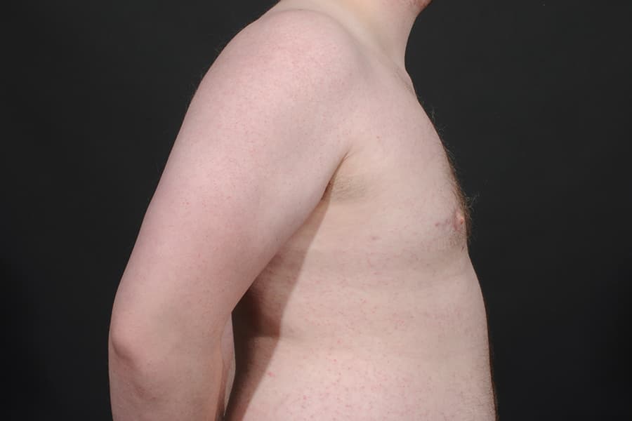 Male Breast Reduction Before & After Image