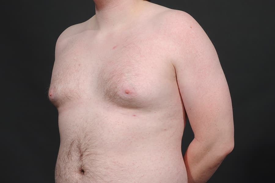 Male Breast Reduction Before & After Image