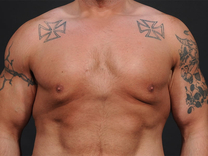 Male Breast Reduction Before & After Image