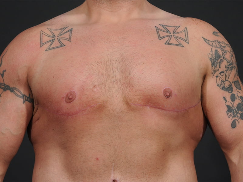 Male Breast Reduction Before & After Image