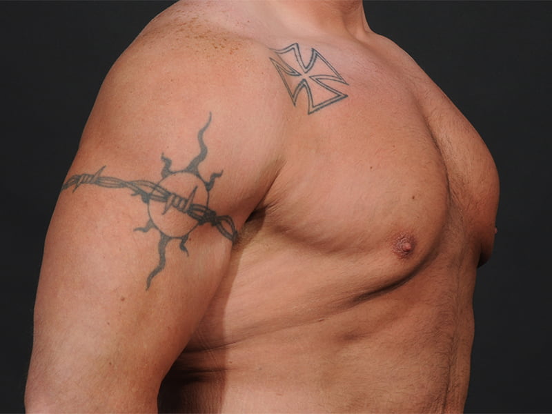 Male Breast Reduction Before & After Image