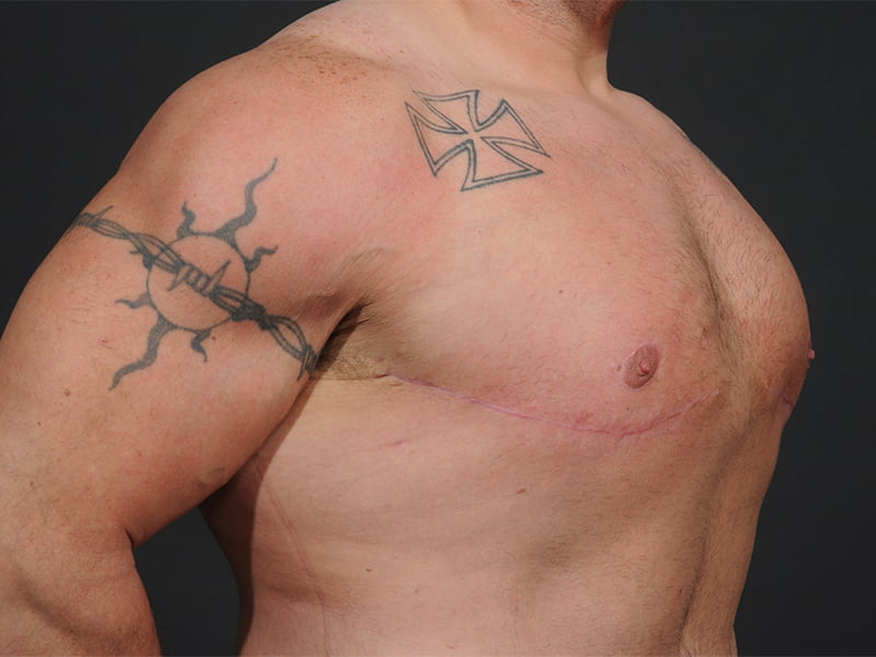 Male Breast Reduction Before & After Image