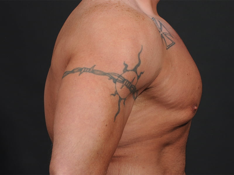 Male Breast Reduction Before & After Image