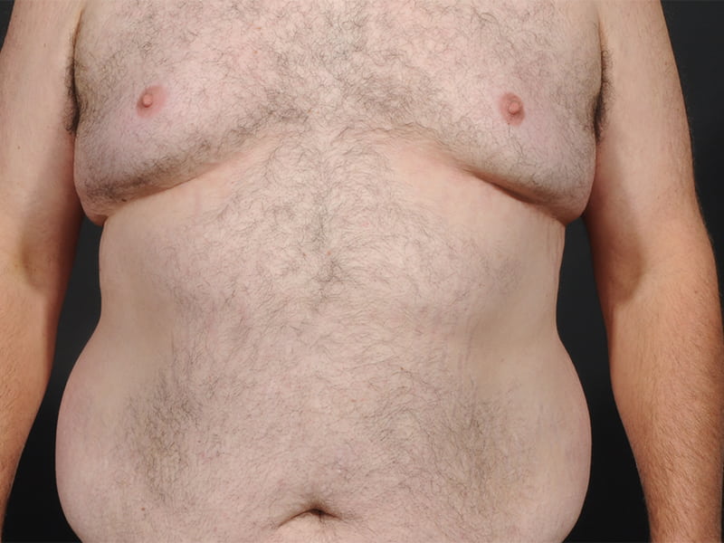 Male Breast Reduction Before & After Image