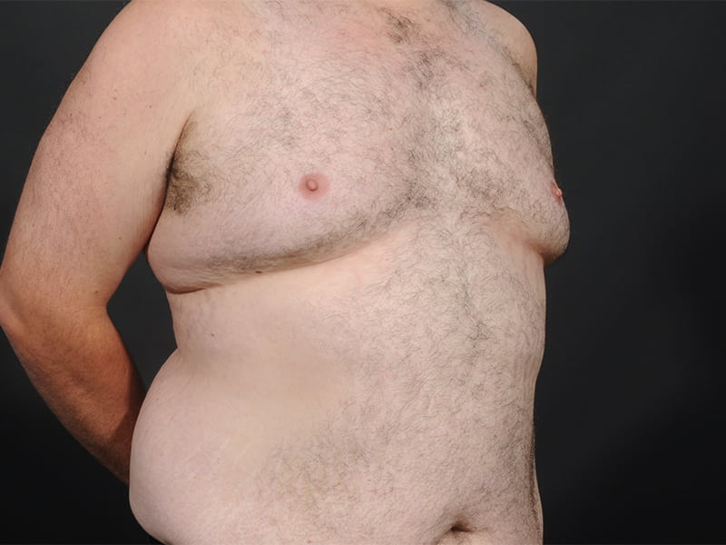 Male Breast Reduction Before & After Image