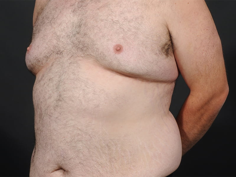 Male Breast Reduction Before & After Image