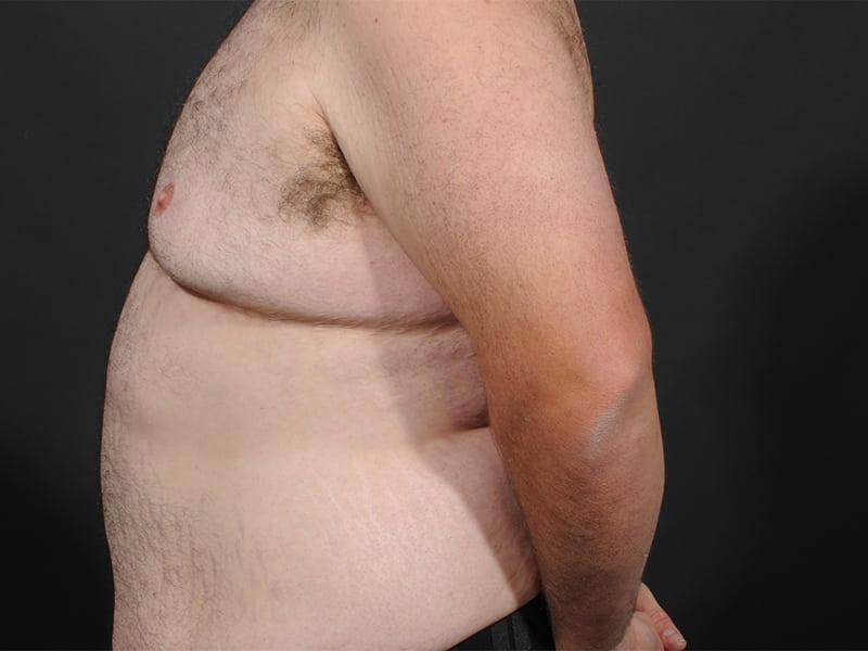 Male Breast Reduction Before & After Image