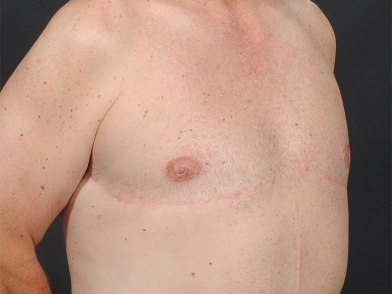 Male Breast Reduction Before & After Image