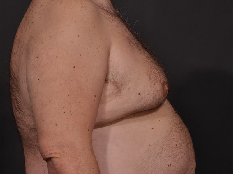 Male Breast Reduction Before & After Image