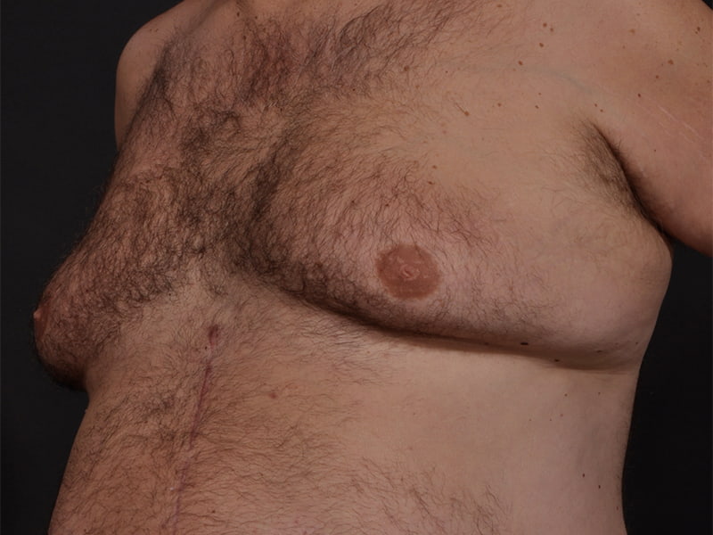 Male Breast Reduction Before & After Image