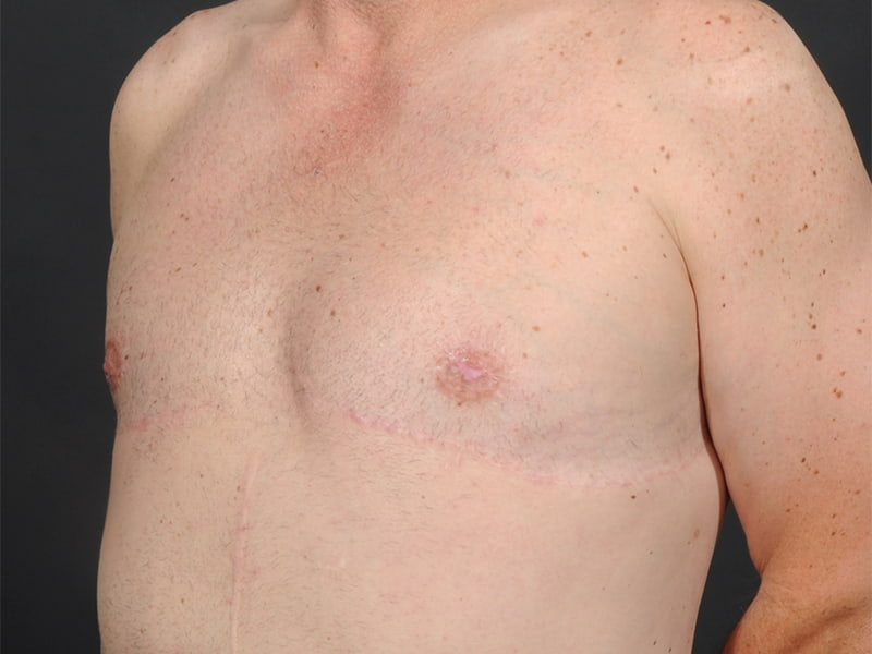 Male Breast Reduction Before & After Image