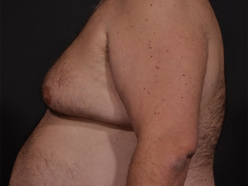 Male Breast Reduction Before & After Image