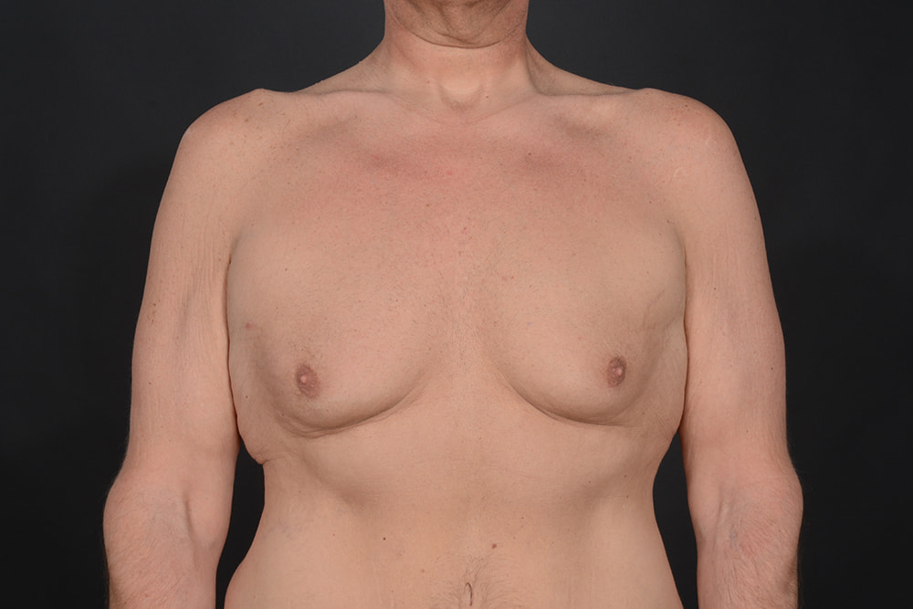 Male Breast Reduction Before & After Image