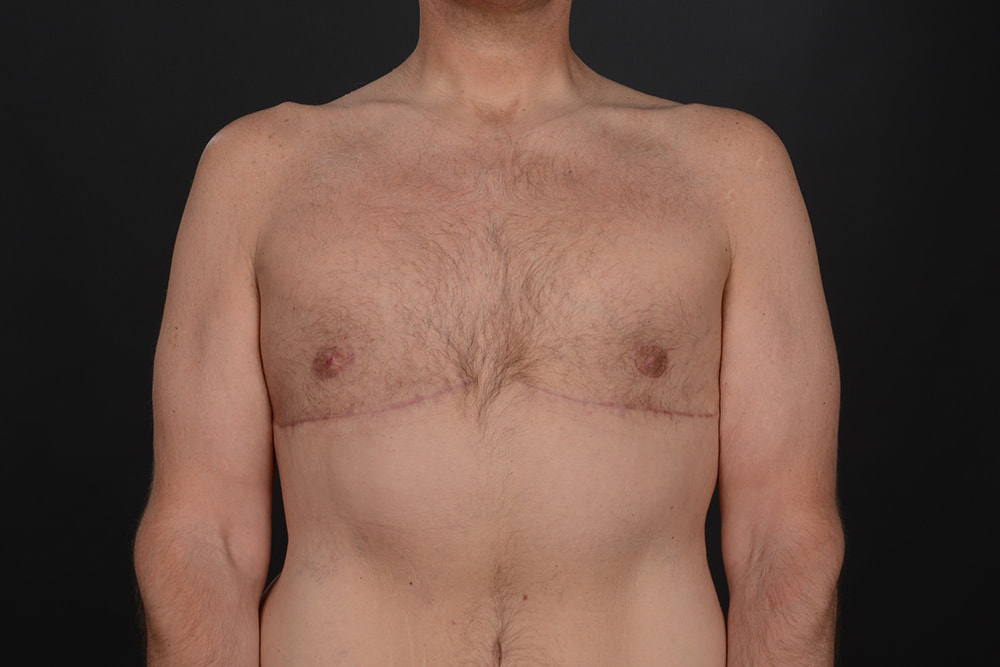 Male Breast Reduction Before & After Image