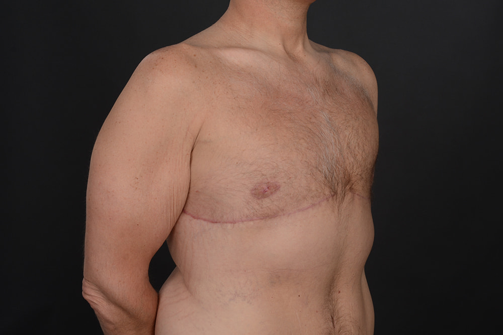 Male Breast Reduction Before & After Image