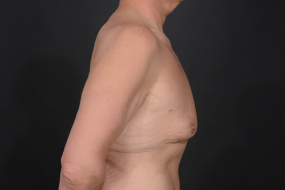 Male Breast Reduction Before & After Image