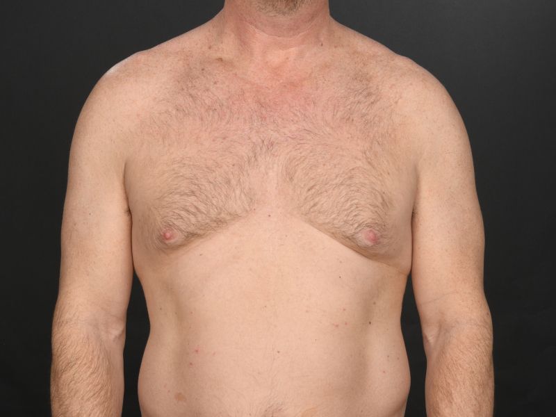 Male Breast Reduction Before & After Image