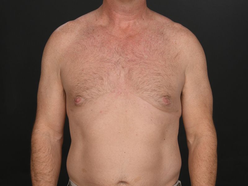 Male Breast Reduction Before & After Image