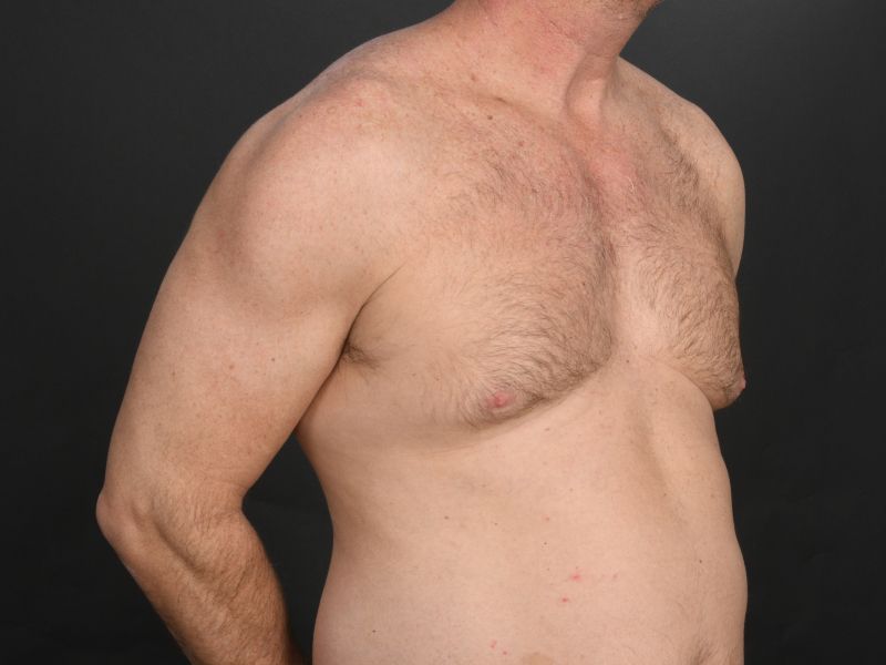 Male Breast Reduction Before & After Image