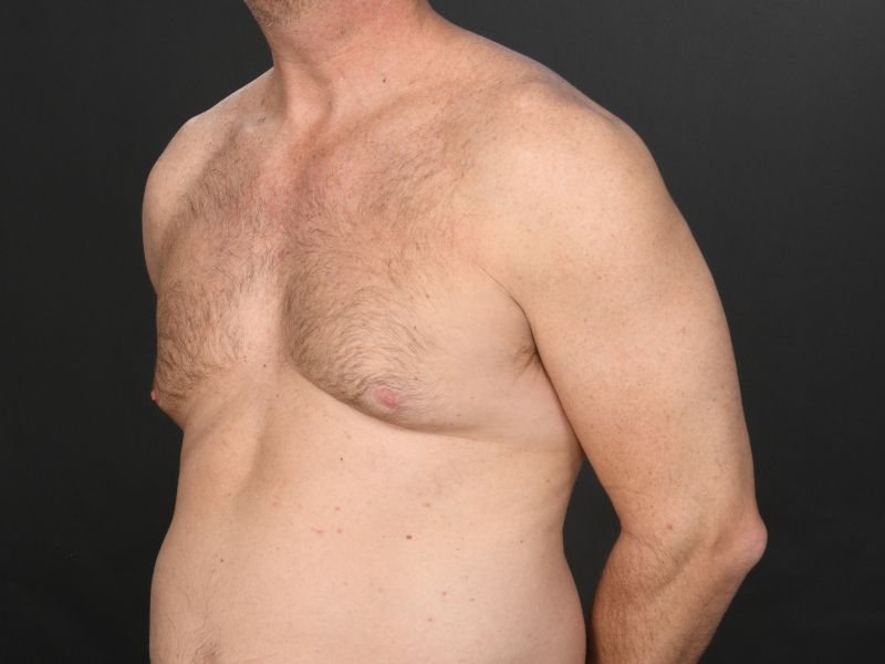 Male Breast Reduction Before & After Image