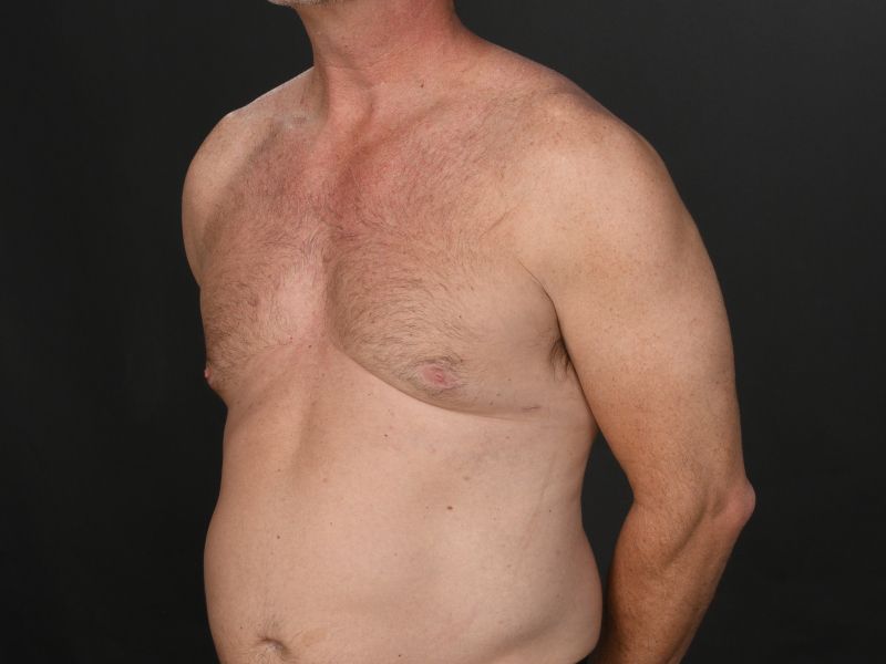 Male Breast Reduction Before & After Image