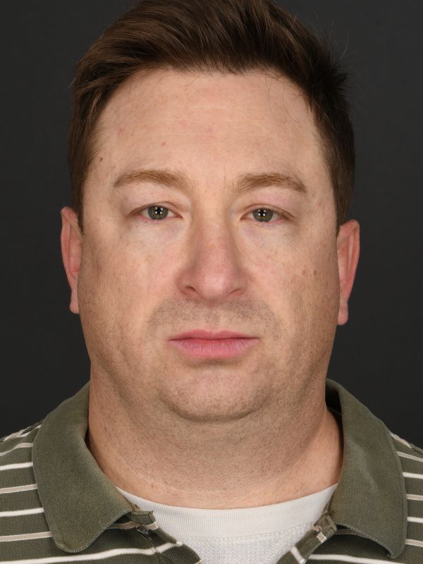 Male Neck Lift Before & After Image