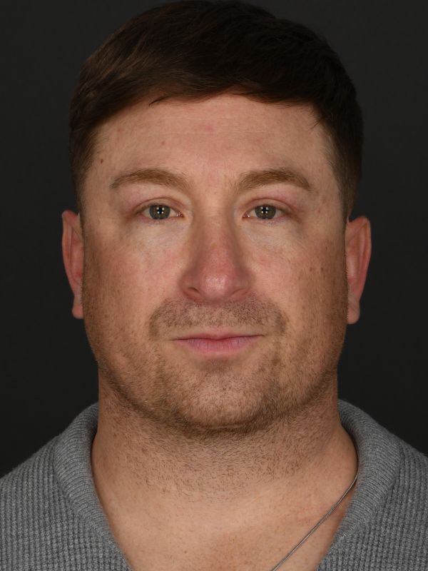 Male Neck Lift Before & After Image