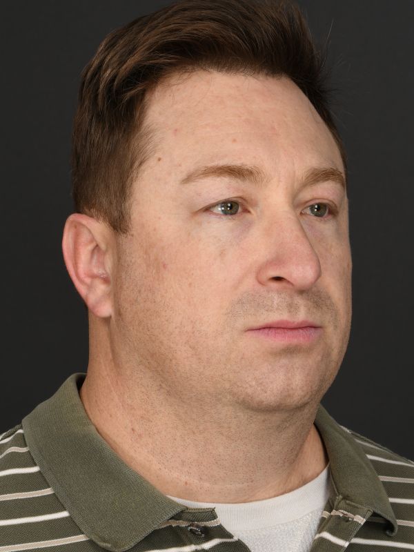 Male Neck Lift Before & After Image