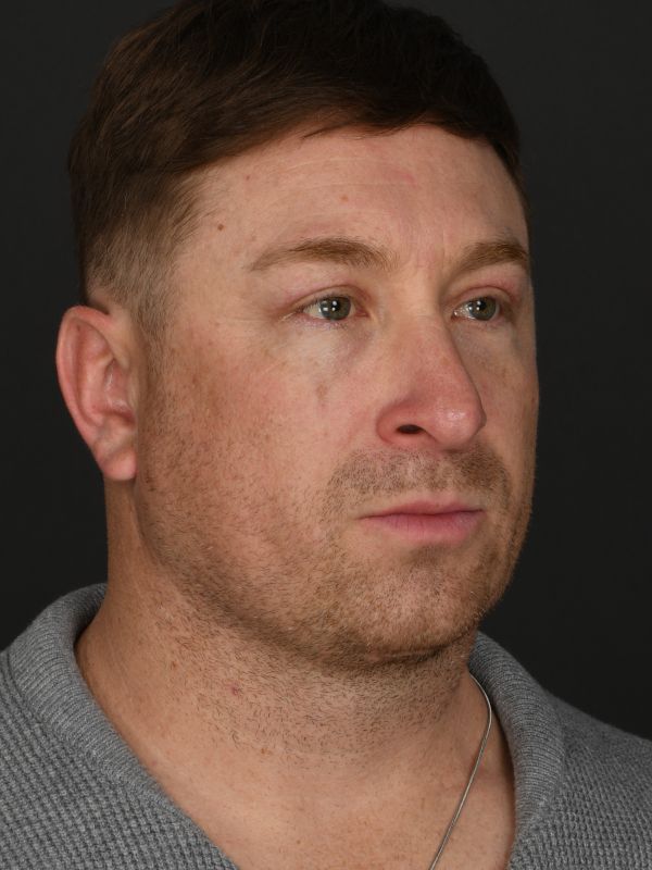 Male Neck Lift Before & After Image