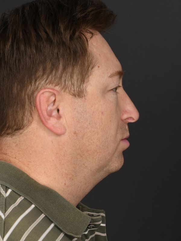 Male Neck Lift Before & After Image