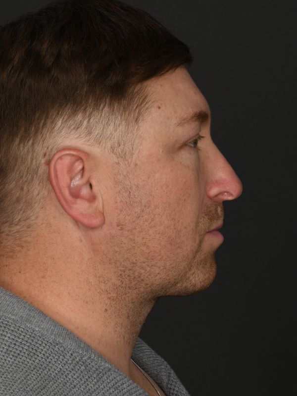 Male Neck Lift Before & After Image