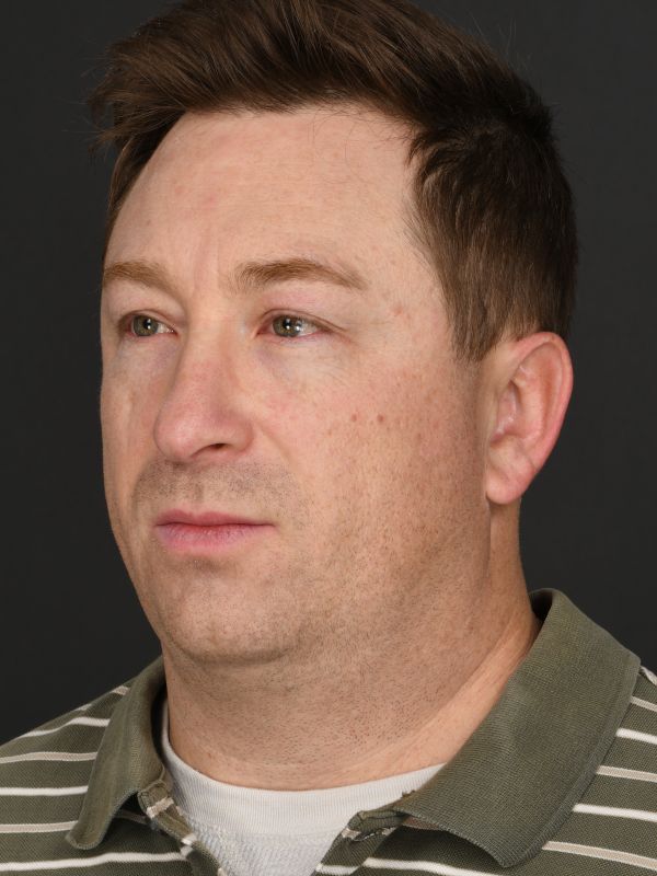 Male Neck Lift Before & After Image