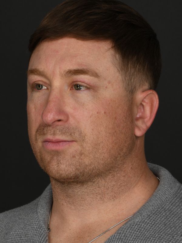 Male Neck Lift Before & After Image