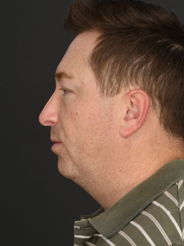 Male Neck Lift Before & After Image