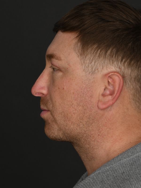 Male Neck Lift Before & After Image