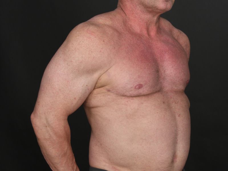 Pectoral Implants Before & After Image