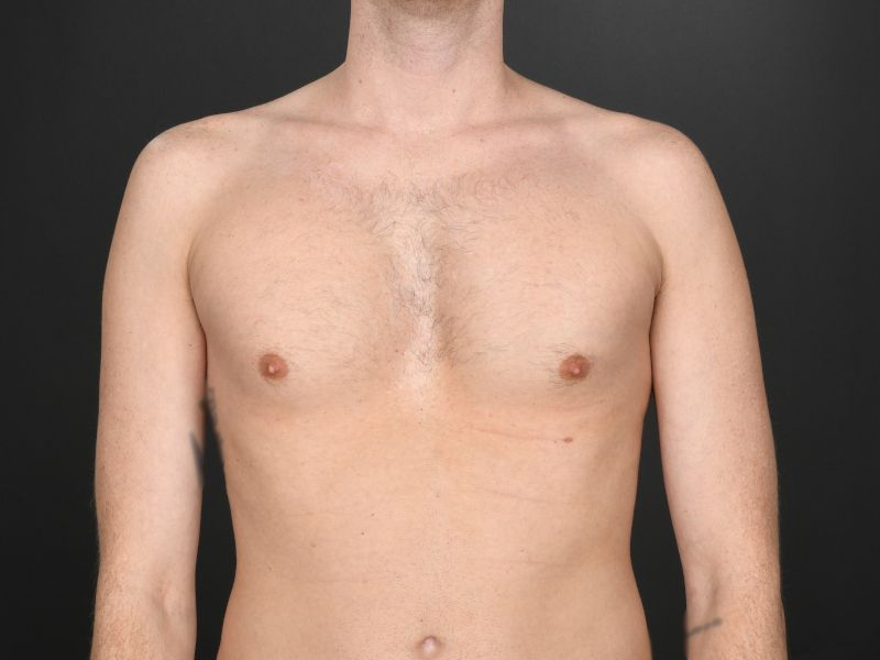 Pectoral Implants Before & After Image