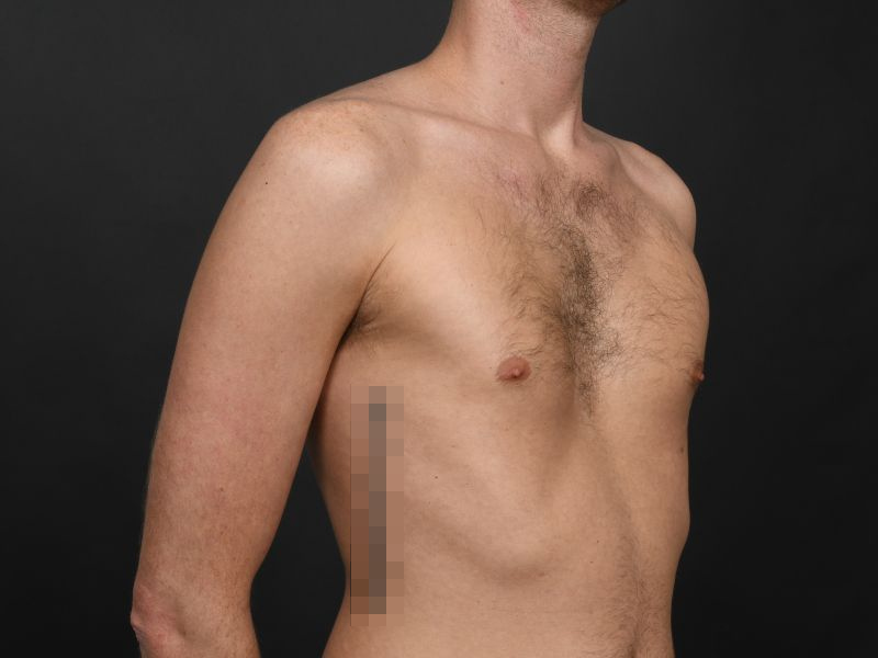 Pectoral Implants Before & After Image