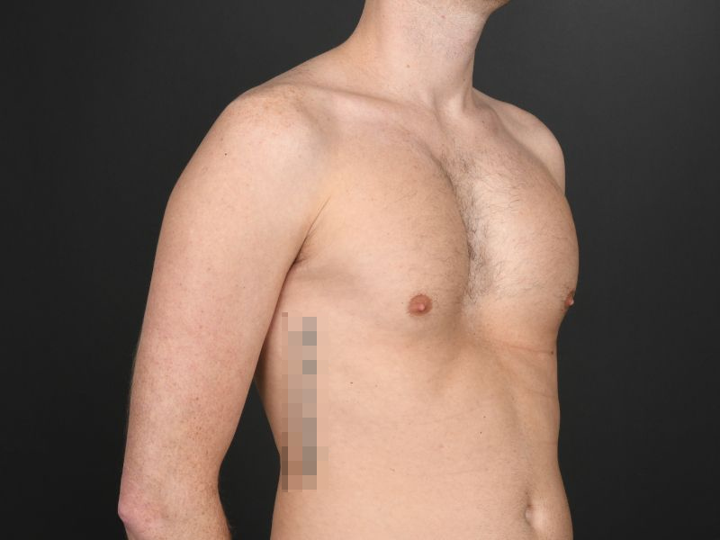 Pectoral Implants Before & After Image